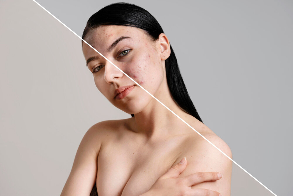 pigmentation reduction